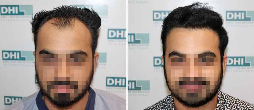 DHI before & after hair transplant results